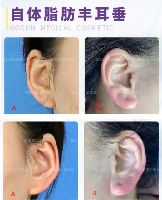 丰耳垂术助你拥有饱满丰盈的耳垂