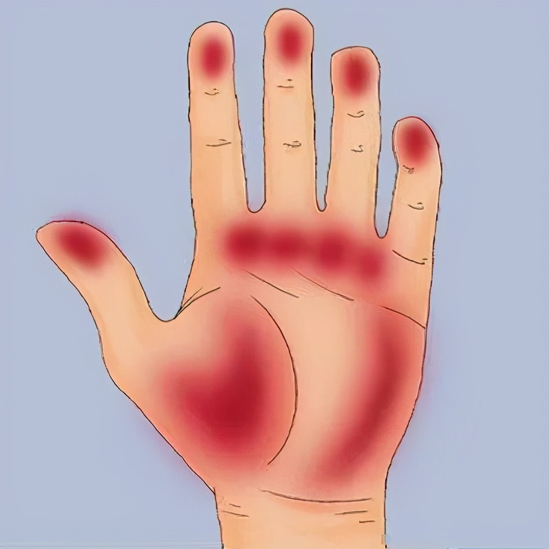 肝脏求救信号之"手掌篇",肝掌是什么?并发症有哪些?__凤凰网