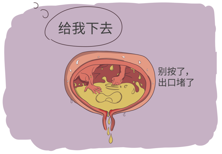 造成 膀胱出口的梗阻.