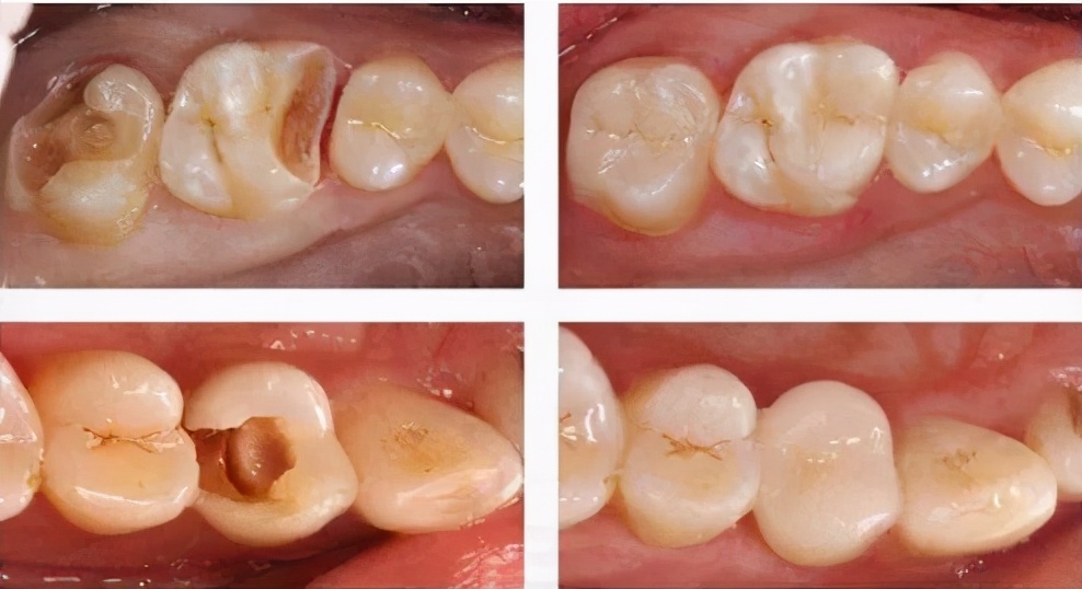 牙齿出现小牙洞时没在意,最终导致牙髓坏死!该咋办?