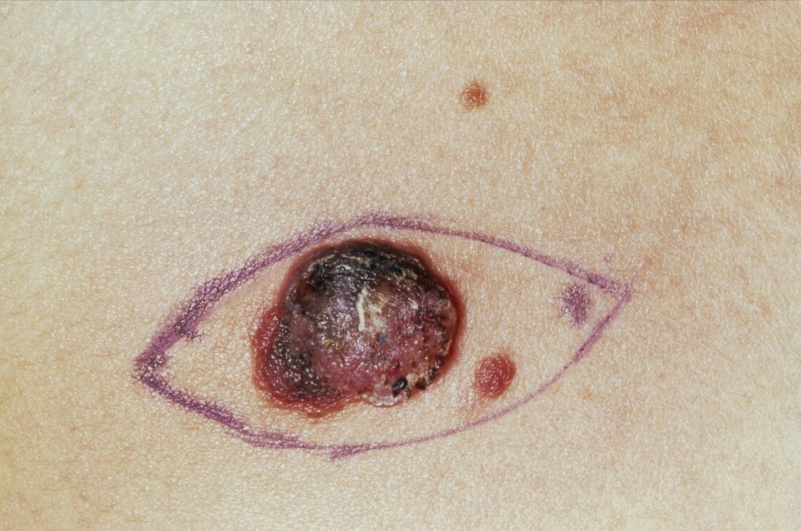 体外肉瘤图片图片