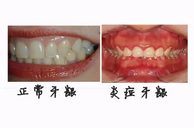 牙龈长脓包居然自己去戳破?这样做后果不堪设想