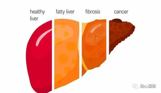 三部曲是不是每个乙肝患者的必然之路呢?