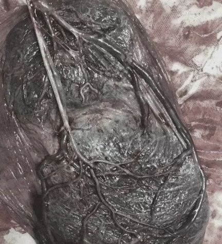 当心!临床你可能会遇见这 7 种特殊的胎盘