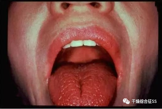 中医辨证:干燥综合征之阴虚津亏证