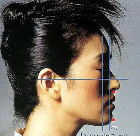 直颌侧面轮廓,前倾侧面轮廓,后倾斜侧面轮廓.