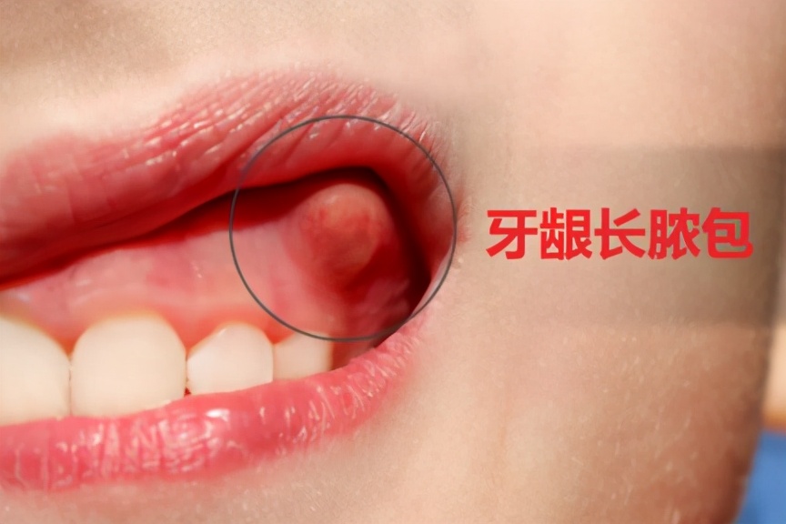 牙龈长脓包居然自己去戳破?这样做后果不堪设想__凤凰网