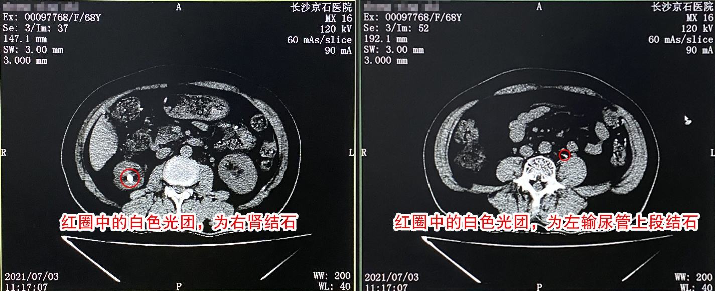 娭毑患结石手术难,家属强塞红包给医生,结局让人破防__凤凰网