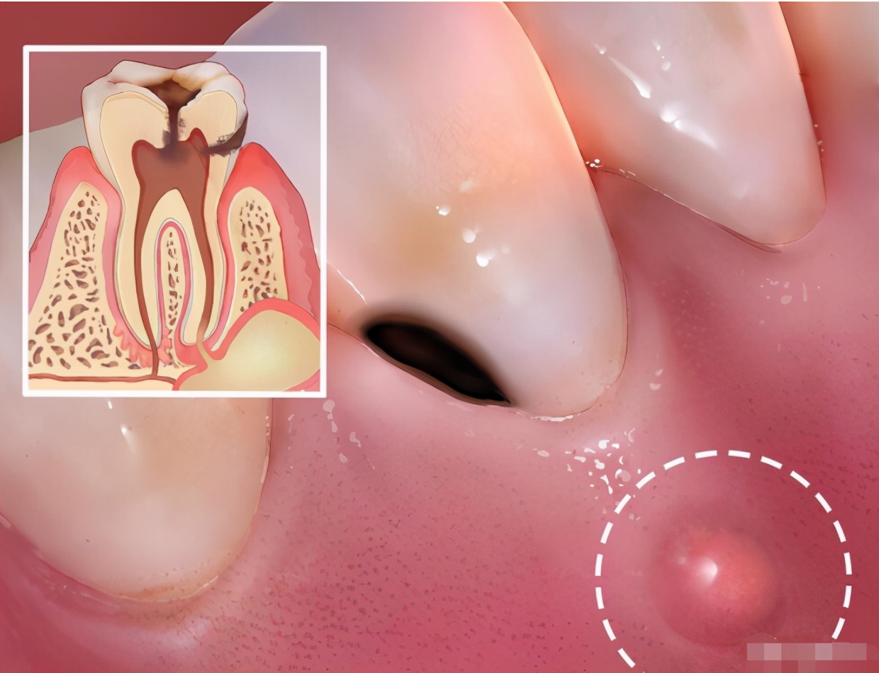 蛀牙治疗不及时,可能会导致根尖周囊肿