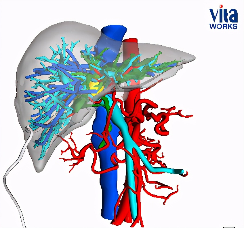 遇到肝胆外科最难手术医生术前3d打印一个肝脏备用