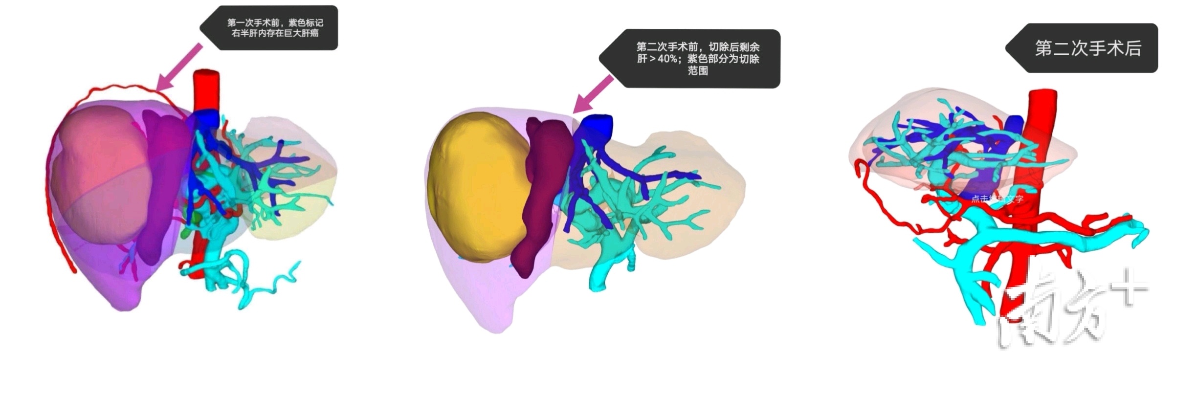 深圳首家!深大总医院引进全球领先肝癌人工智能AI临床决策系统