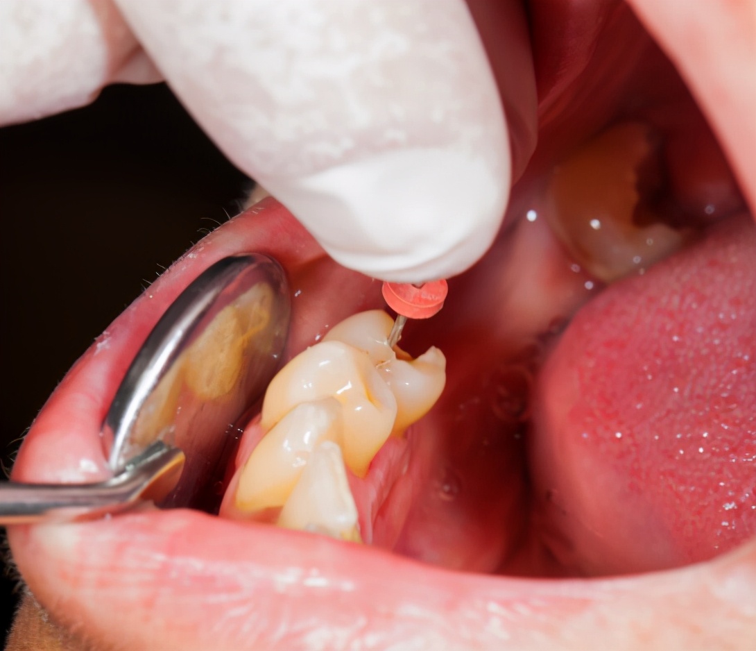 做完根管治疗后,牙齿又痛又出血!该怎么办?