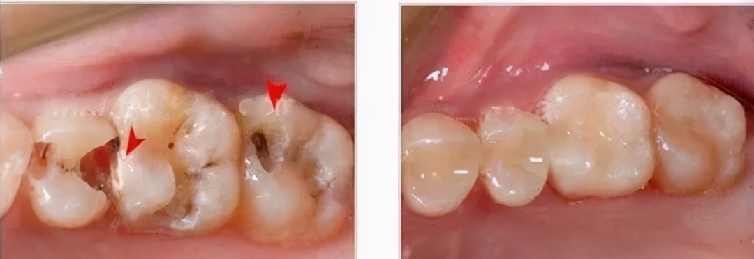 在廊坊,有些人牙齒都爛了一半,為何不能直接補牙?