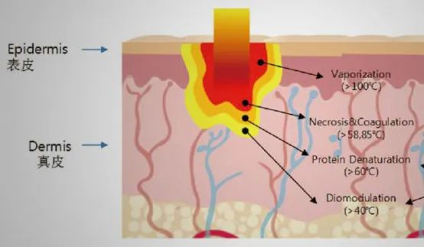 什么是光电治疗光电治疗后皮肤有色沉和返黑？做好术后修复更关键_https://www.jmylbn.com_新闻资讯_第2张