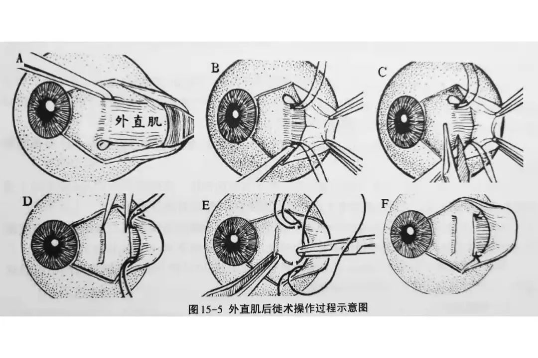 斜视手术肌肉缝合图解图片