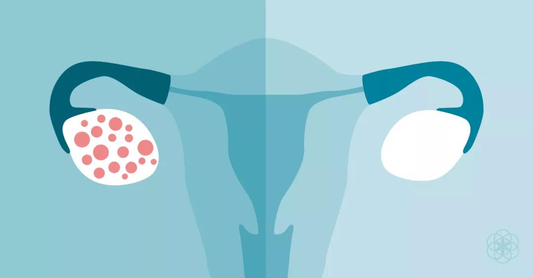 上海瑞金医院陆小溦医生多囊卵巢pcos饮食和锻炼