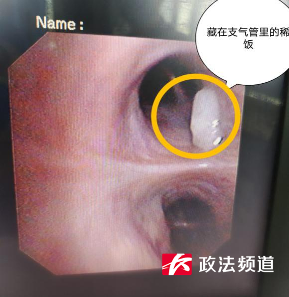 一碗稀饭下肚,49岁男子呼吸衰竭住进icu!这几种情况要注意