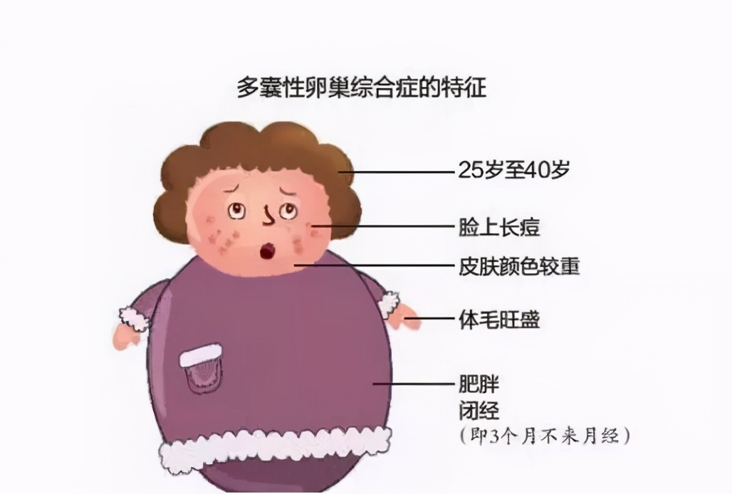 委婉!20岁女孩多囊卵巢怎么办"任重道远"-第1张图片-南坊网