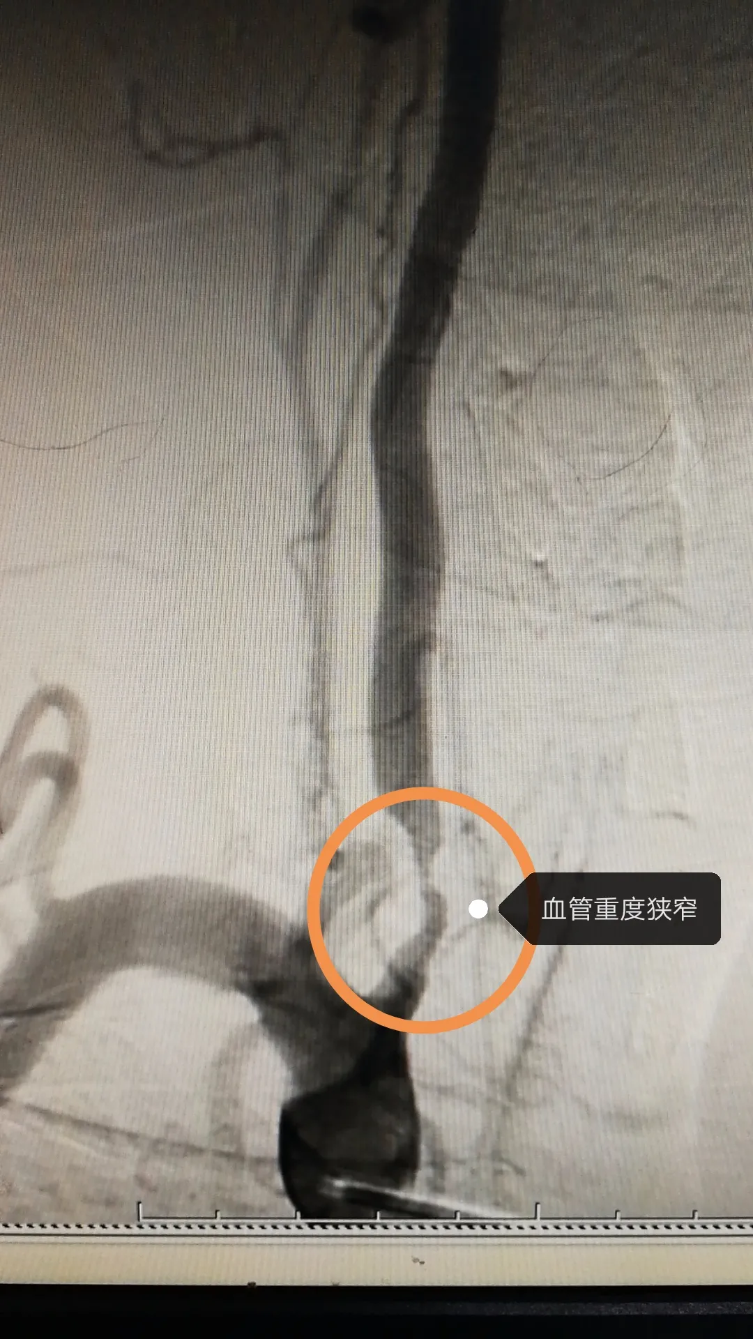 老人反复头晕近10年走路像在踩棉花竟是椎动脉重度狭窄惹的祸