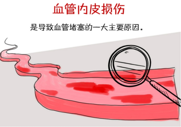 通心络修复血管损伤是对心脑血管病有效的防治_凤凰网