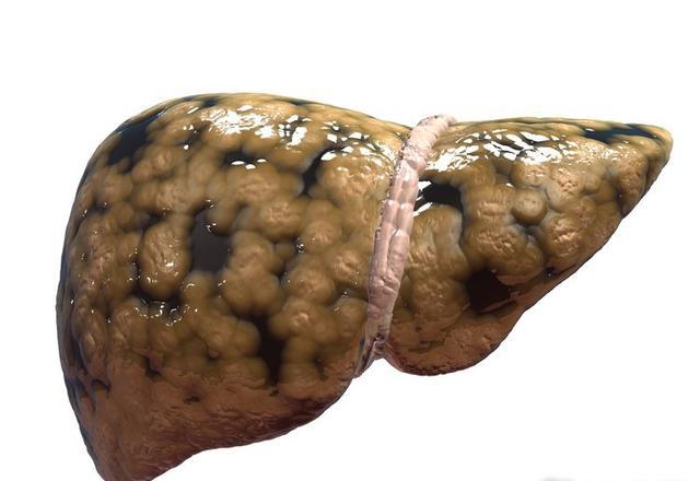 脂肪肝病变肝癌只有五步这个过程很快别轻视它