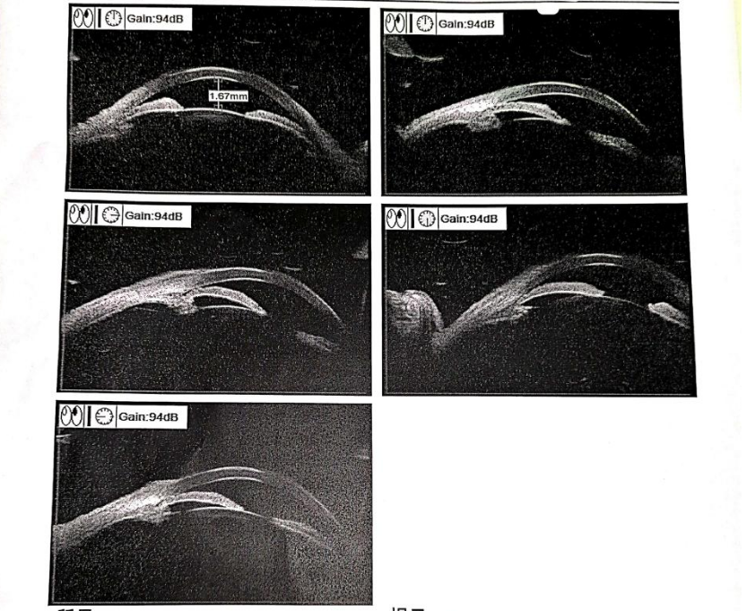 致盲性眼病青光眼可以预防吗听听专家怎么说