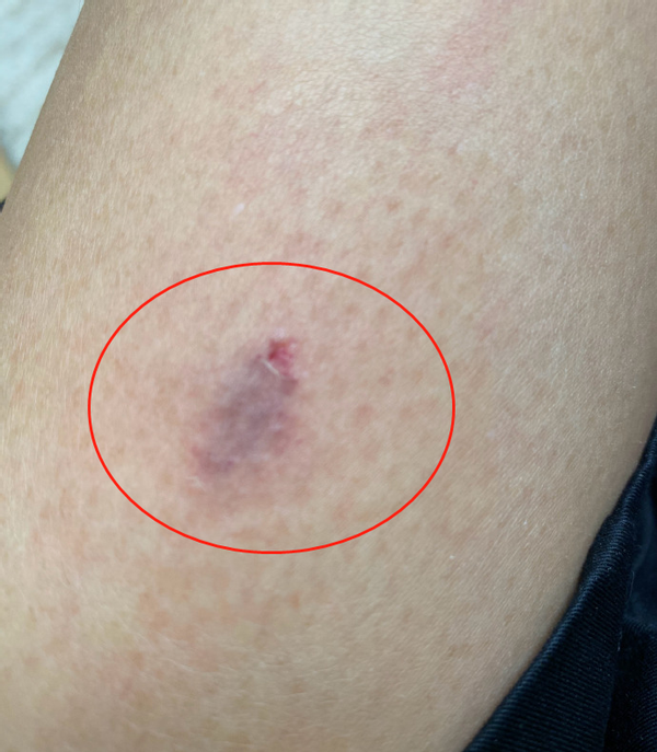 蔡少芬录制节目突然被狗咬伤口破皮红一大片深夜紧急前往医院