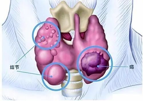 几乎都谈癌色变,幸运癌近80%能治愈的甲状腺癌你了解多少呢?