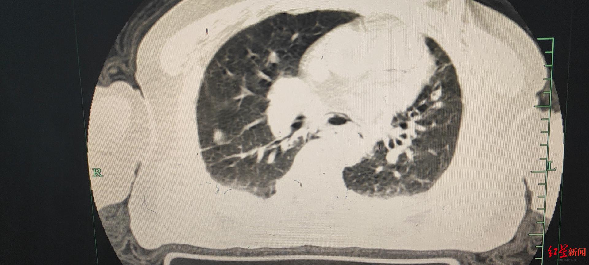 "综合考虑,我们觉得很有可能是食管破裂.