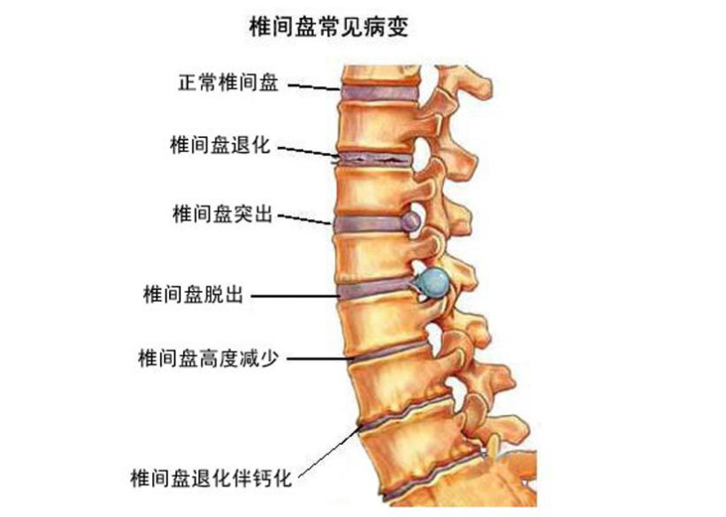 人的腰椎间盘位置图图片