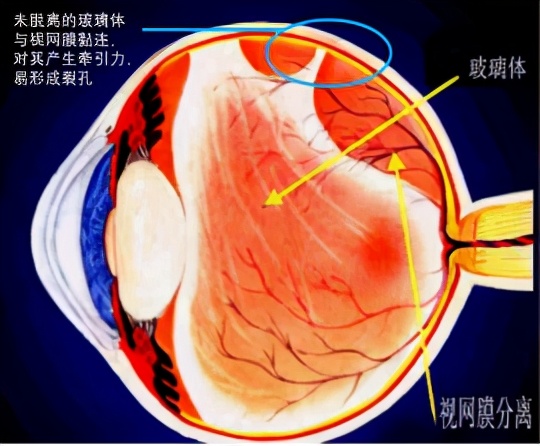 部分患者icl手术前要打激光 为什么 凤凰网