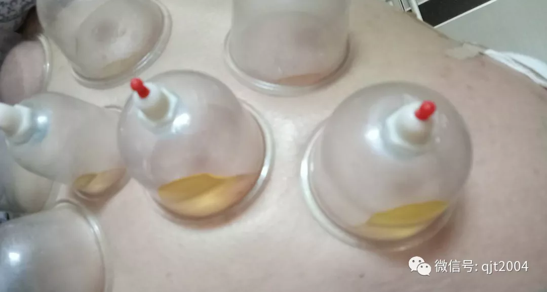 拔罐拔出果冻状物质你见过吗?__凤凰网
