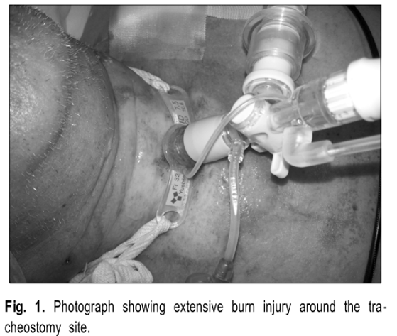 为什么手术用电刀患者痔疮手术中放了个屁，居然引发一场火灾_https://www.jmylbn.com_新闻资讯_第2张