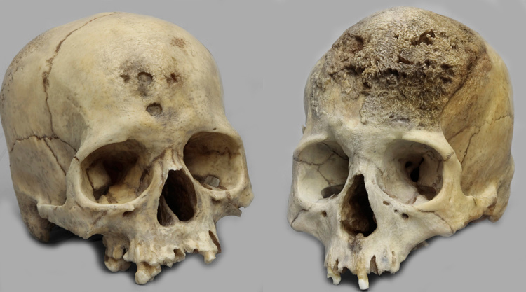 梵高,贝多芬,尼采均身患"木每毒","木每毒"成就天才吗?