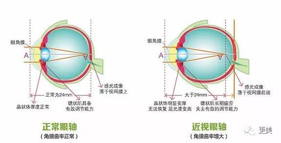 正常人眼球突出度是在12~14mm,双眼相差不到2mm,一般男性是13.
