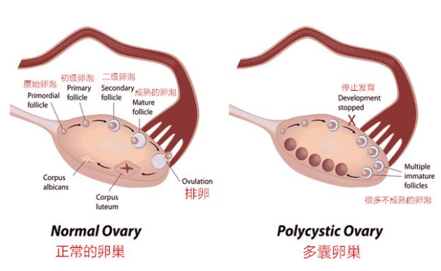 多囊卵巢综合征近期临床表现〔1〕多囊卵巢综合征患者因个体化差异