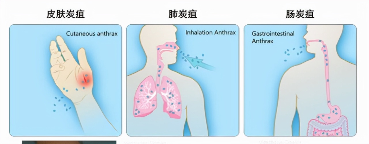 國內接二連三出現炭疽病例:面對這種傳染病,咱們又該如何預防?__鳳凰