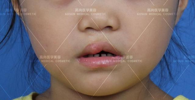 先天性唇腭裂儿童图片