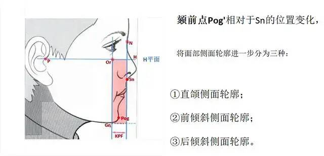 下颌面的立体程度