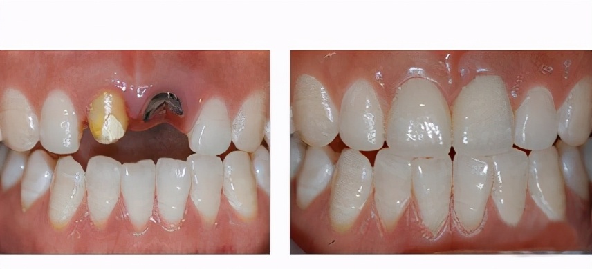 常规种植牙术后7-10天及时拆线,及时拆线可以预防局部感染.