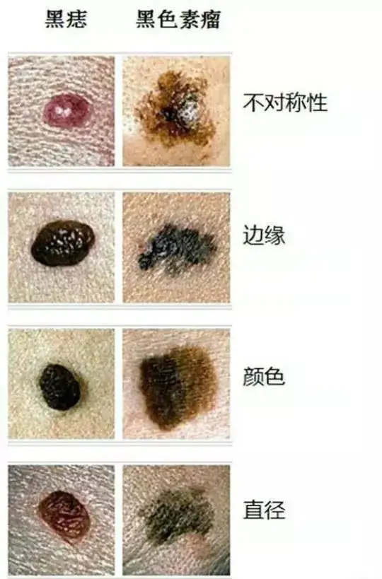 「未来医生」小小的痣也会癌变?小心是黑色素瘤