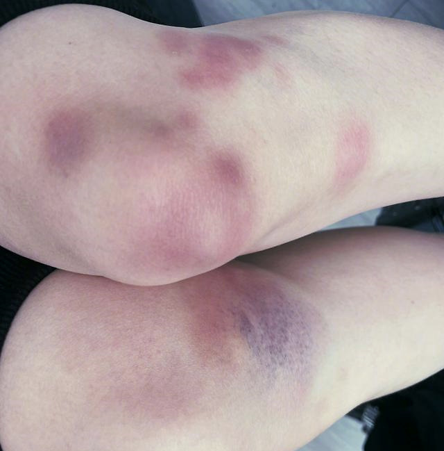 女生大腿青紫图片