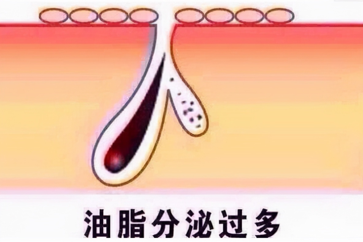 要祛痘先要明白爆痘痘的原因，再就是多注意这些，祛痘不难_凤凰网, image size:1184x790