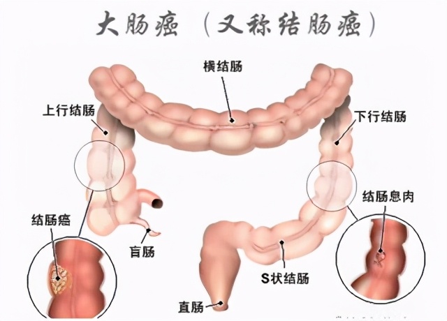 大肠癌好发部位图片图片