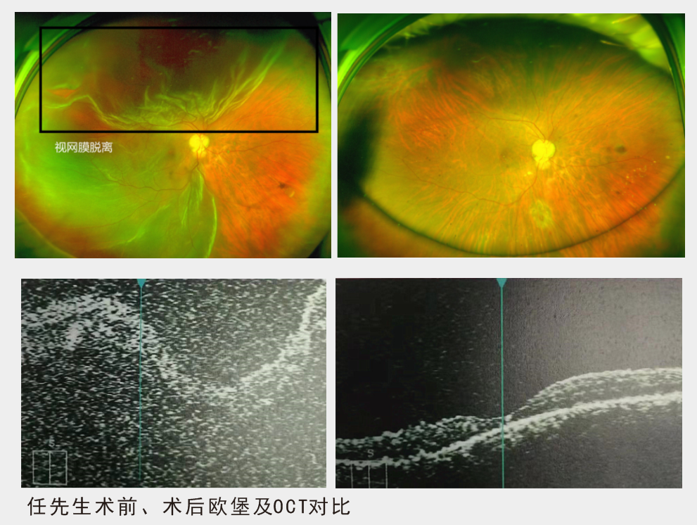 2名视网膜脱离患者险失明，怀化爱尔24小时急救护光明 凤凰网