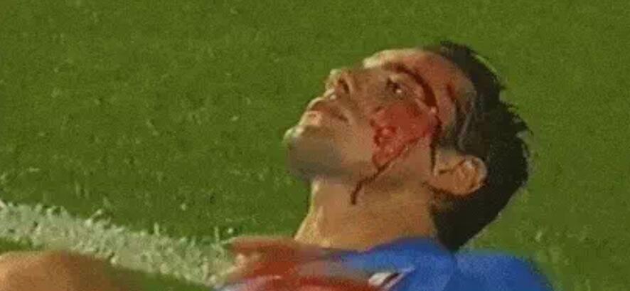意大利球员血流满面。