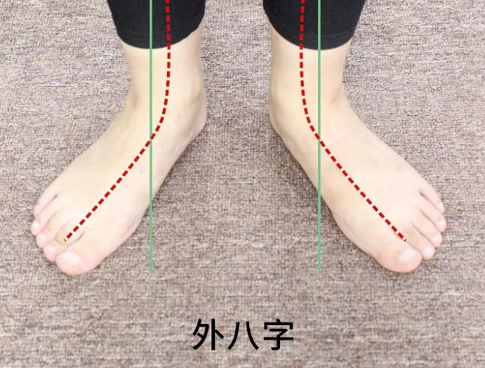 以上的几种运动都是可以矫正外八字脚的,除此之外,在生活中女性们还