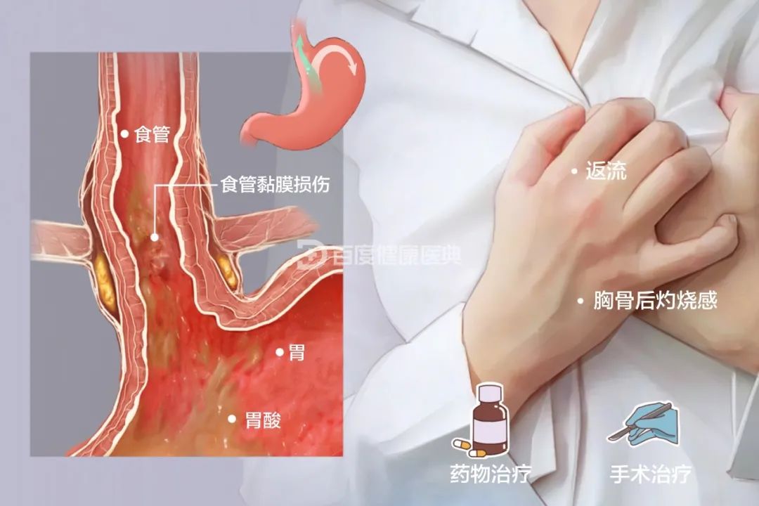 胃食管反流病的症狀