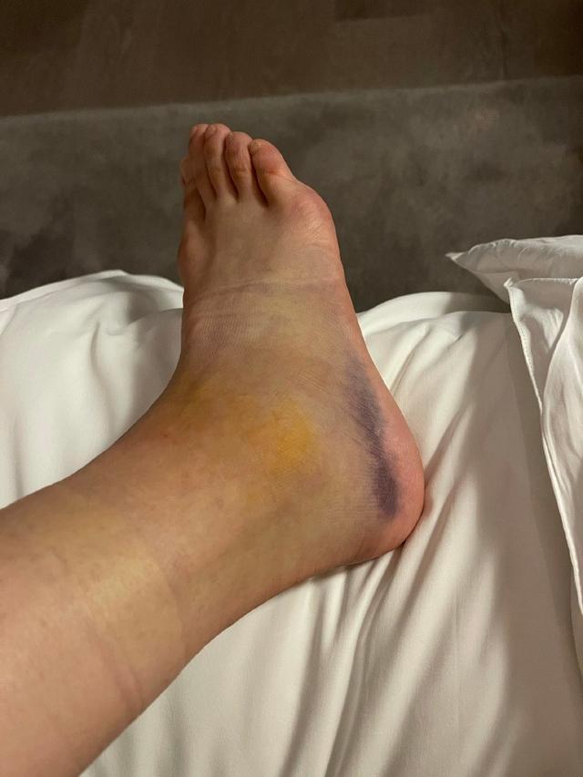 袁咏琳自曝淤血3周后才知韧带撕裂,后果严重要手术