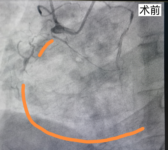 左前降支和左迴旋支中的前兩根已經完全堵塞,剩下的一根堵